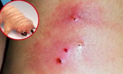 parasito carnivoro en humanos