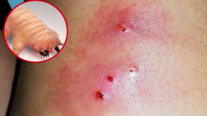 parasito carnivoro en humanos