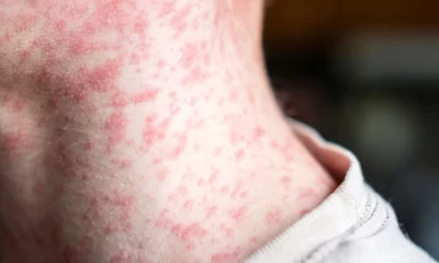 alerta epidemiológica sarampión Américas